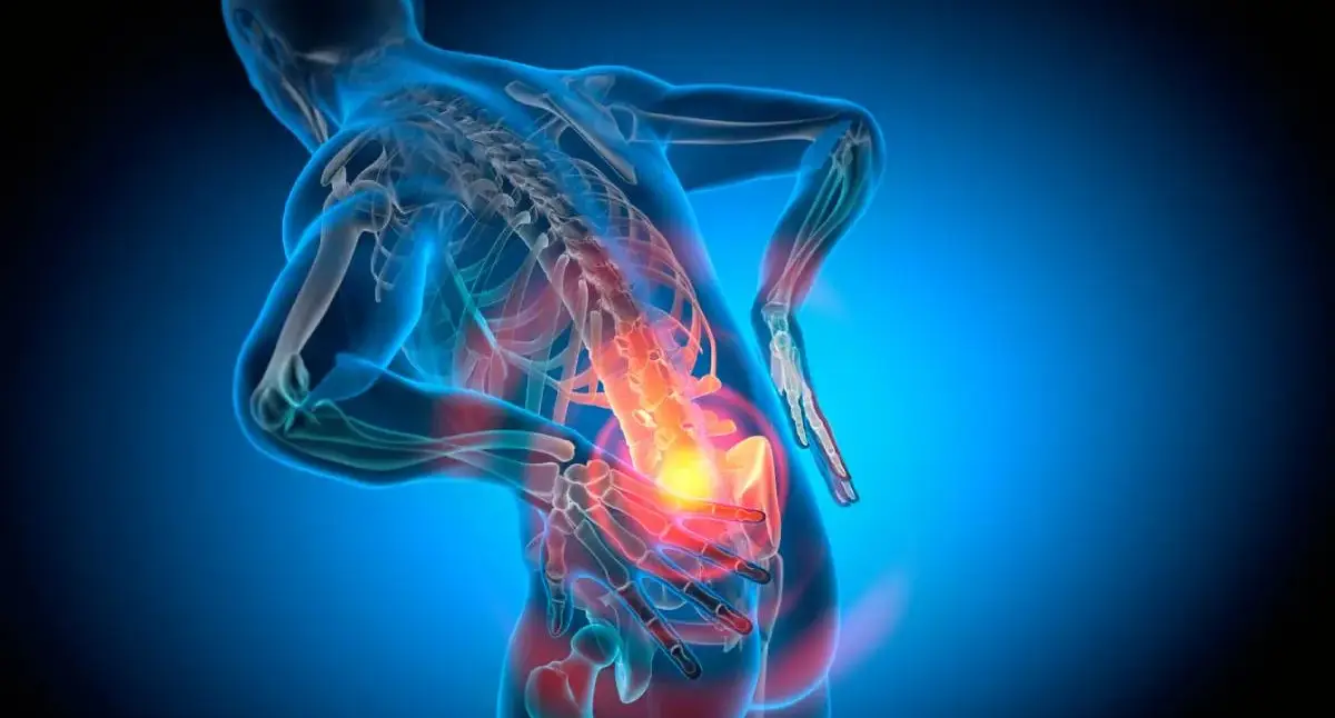 Medical illustration showing the spinal cord within the spinal canal with a narrowed area compressing the cord.