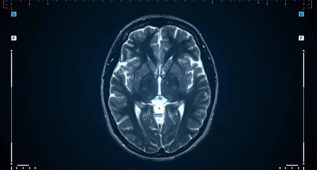 Illustration of the brain and meninges highlighting common meningioma locations