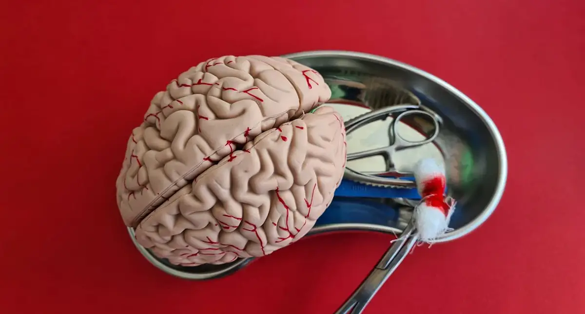 Medical illustration showing enlarged brain ventricles consistent with hydrocephalus