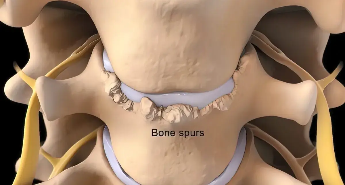 Patient reviewing pre-op checklist before bone spur repair surgery