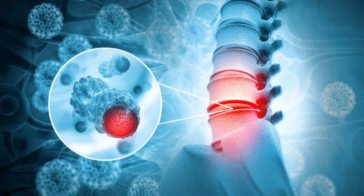 Adult holding their lower back in discomfort, representing persistent back pain that may need spine tumor evaluation