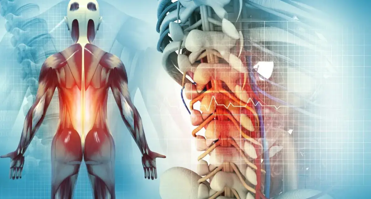 Spinal discs between vertebrae showing dehydration and height loss associated with degenerative disc disease