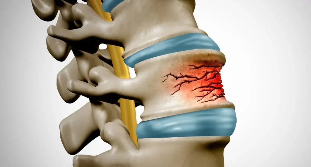 Medical illustration showing a vertebral compression fracture in the spine