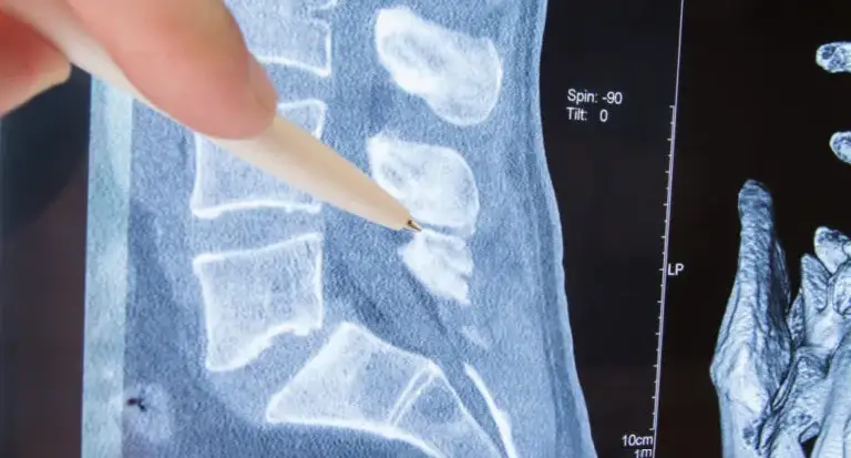 Illustration of spinal stenosis showing a narrowed spinal canal compressing nerves