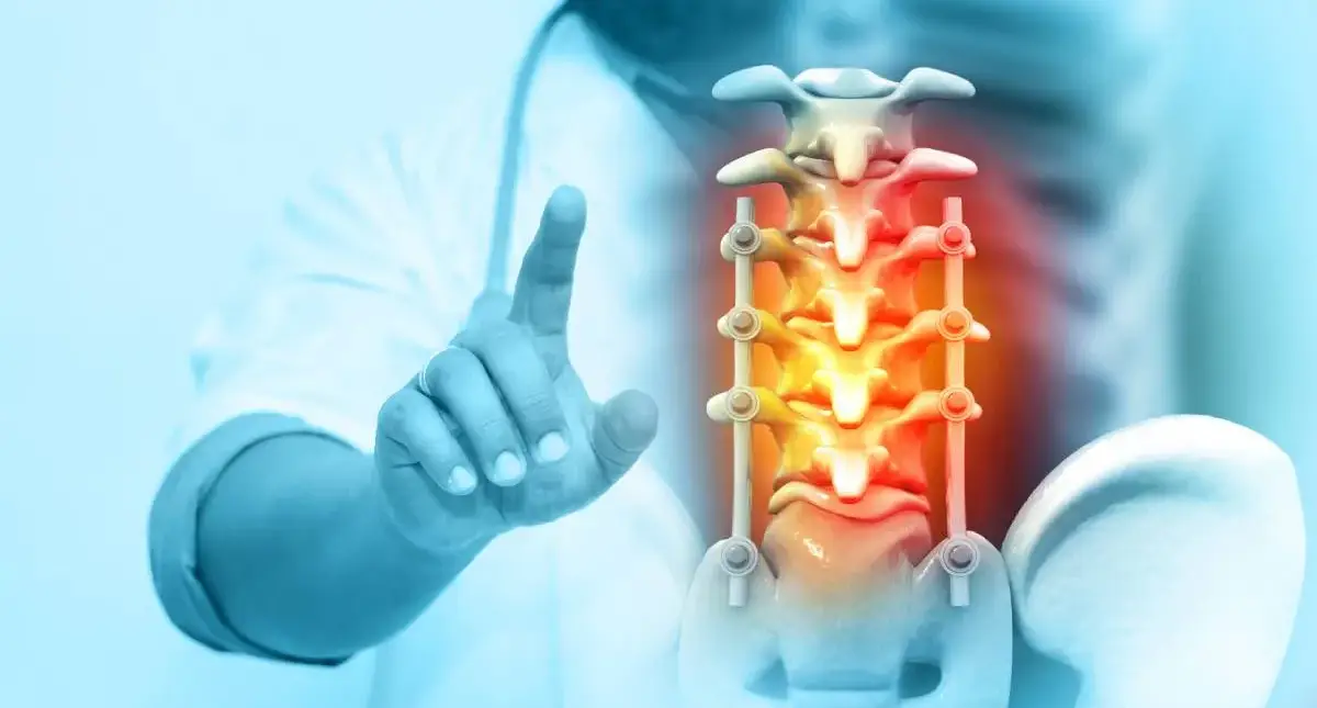 Medical illustration showing spinal canal narrowing that can compress nerves in spinal stenosis