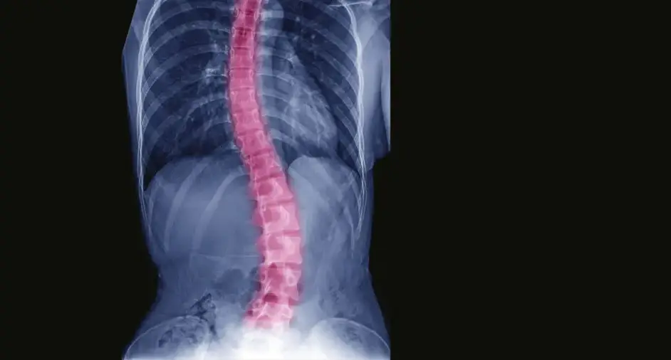 Illustration showing a side-to-side spinal curve consistent with scoliosis