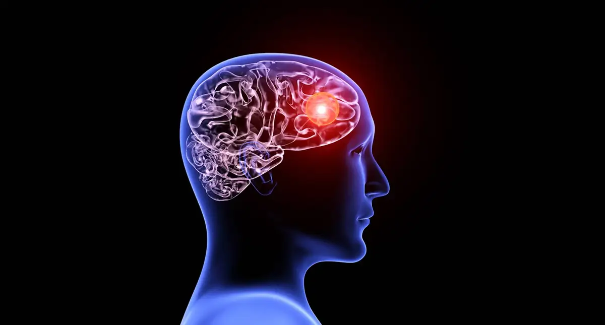 Physician reviewing cerebral blood vessel imaging with a patient discussing family history and aneurysm screening