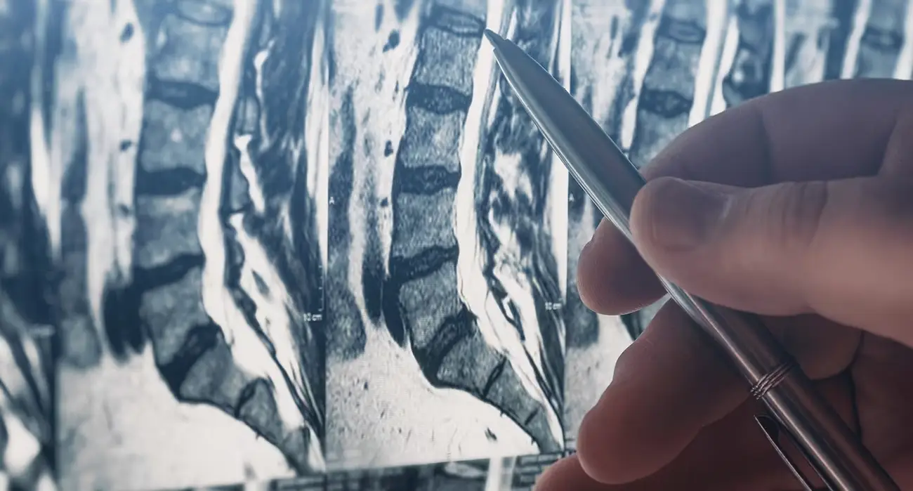 Doctor reviewing spinal MRI scan and pointing to vertebrae for a second opinion MRI consultation with the best spine surgeon in Los Angeles