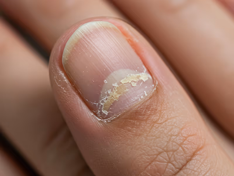 Nail Infection Removal