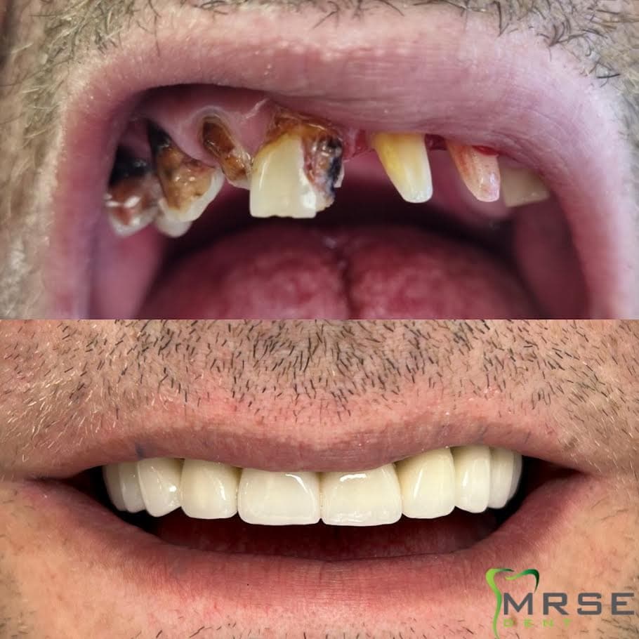mrse4