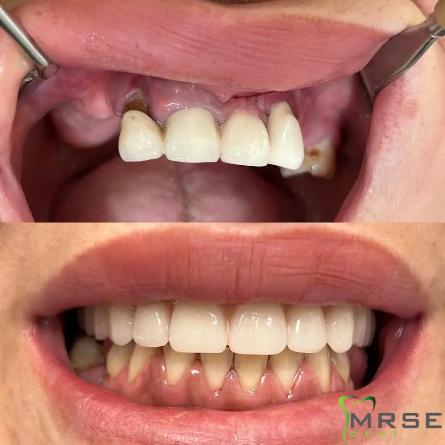 mrse6