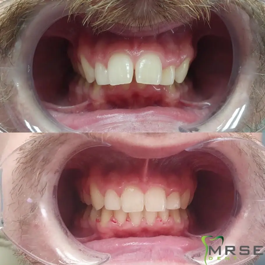 mrse10