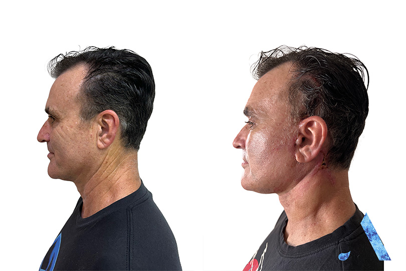 male facelift thailand before and after results