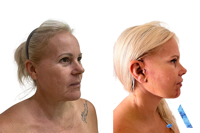 front/side on before and after pictures. cosmetic surgery in thailand. blonde hair