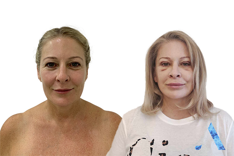 Kym facelift before and after