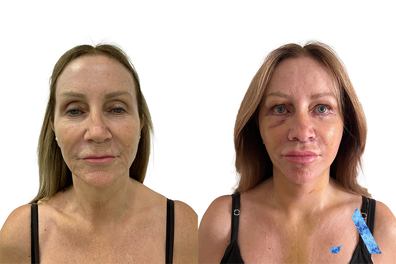 A very happy client smiling after face lift in thailand. showing off her results