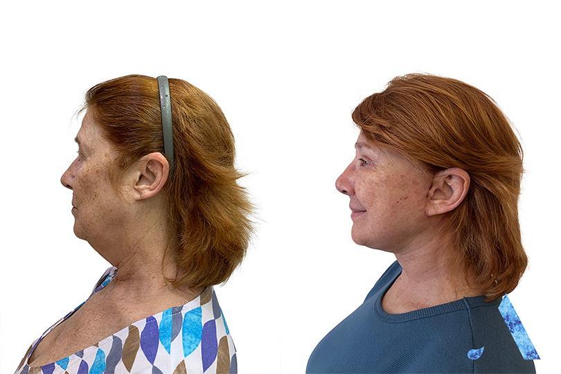 Jill before and after side profile. thailand plastic surgery. face lift. amazing results