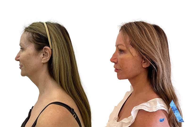 A happy client after her surgery in thailand. image shows amazing before and after results