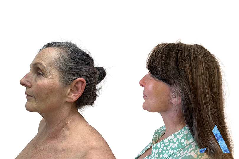 woman face lift results before and after side profile