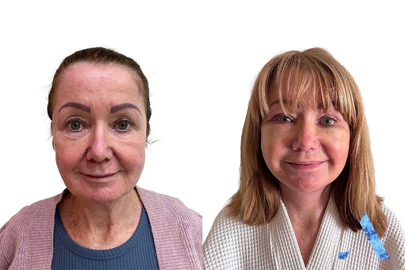 happy lady facelift results in bangkok thailand