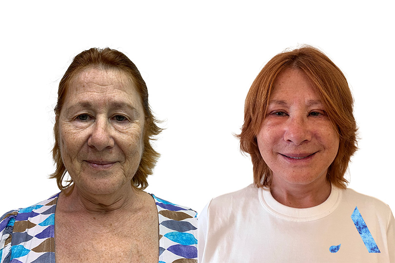 6 days post op after face lift in bangkok before and after