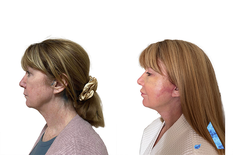 older lady shows off side profile results from face lift in bangkok thailand