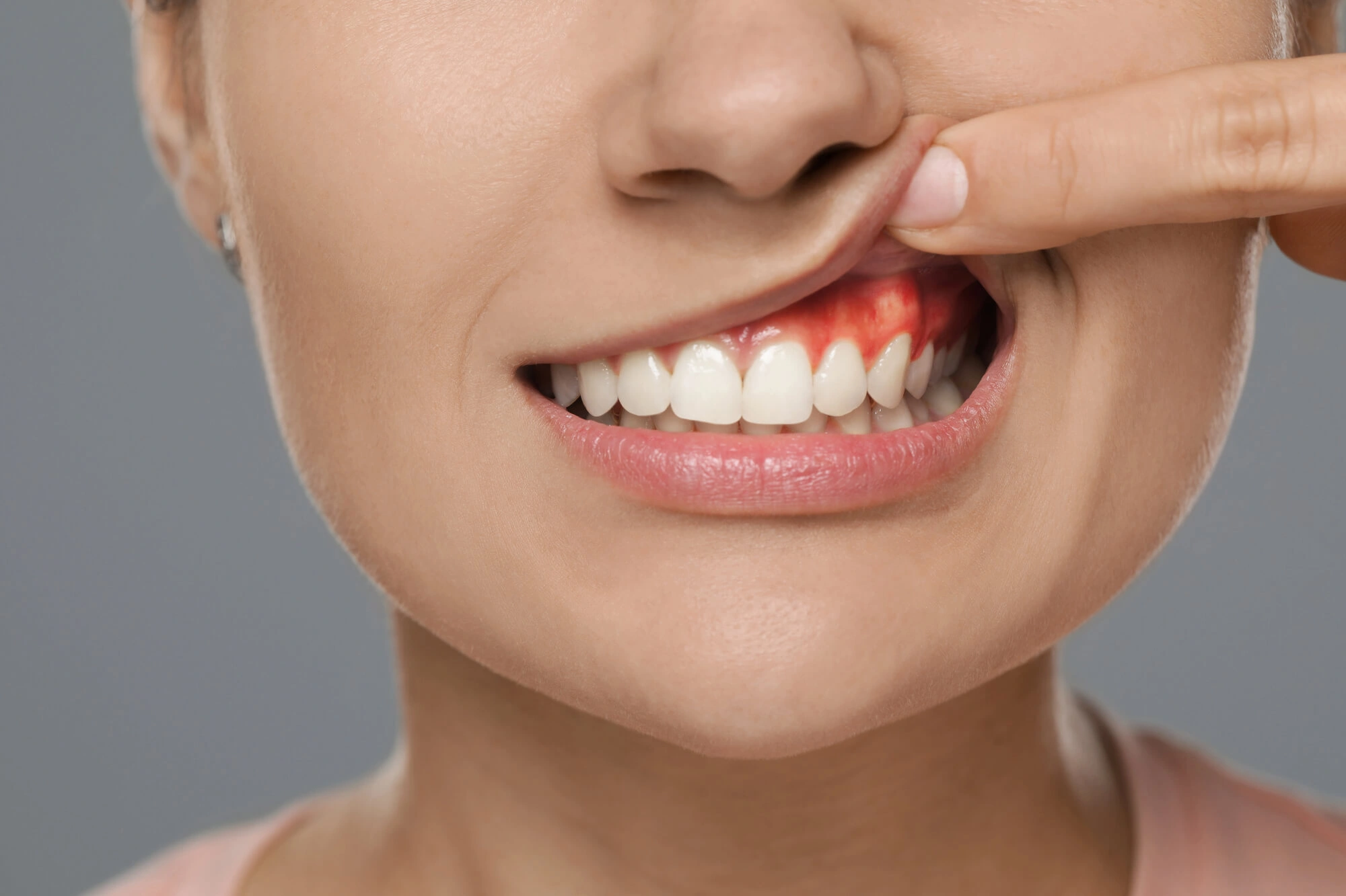 Swollen gums needs Hillsborough Dental Care