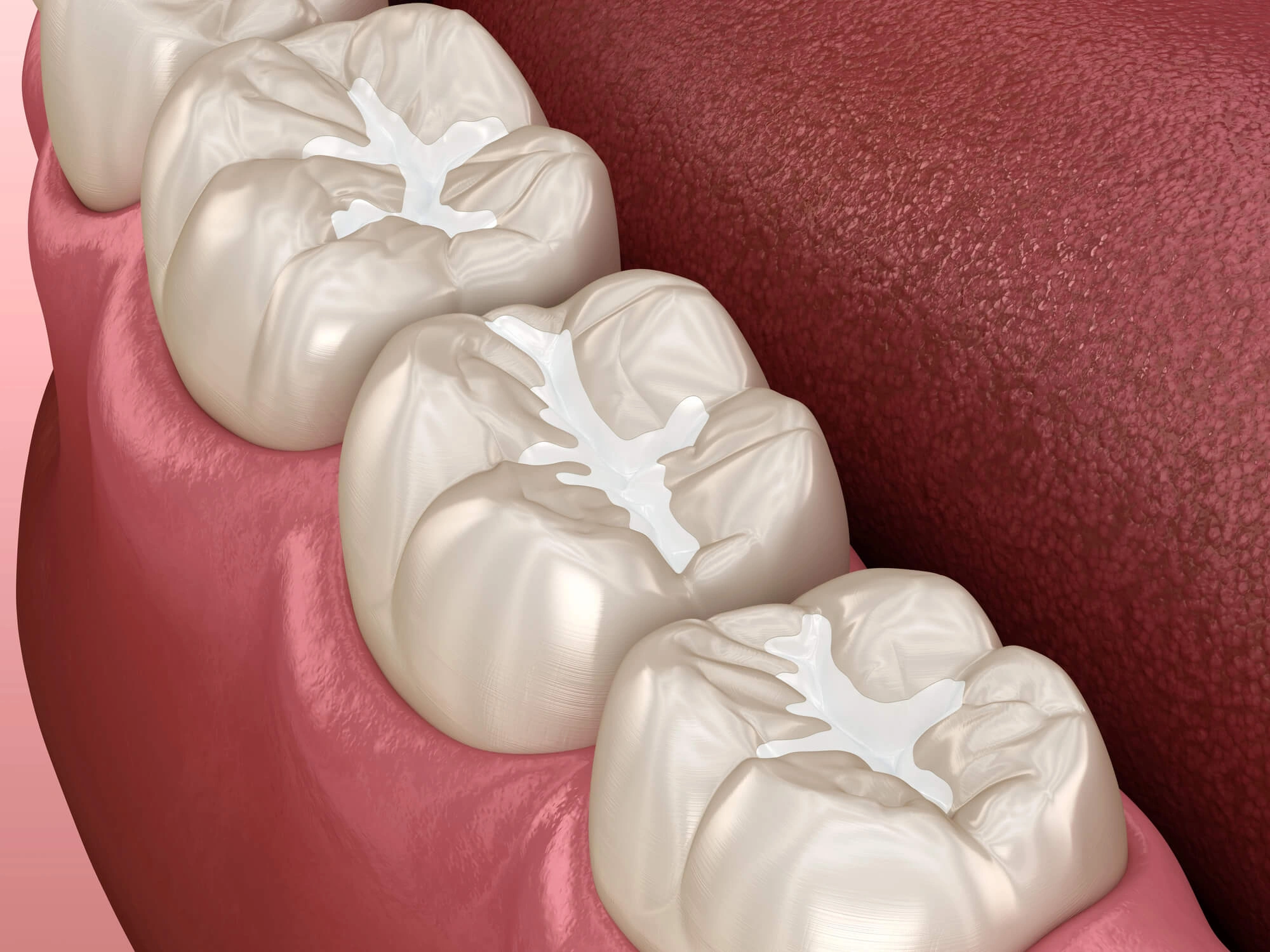 Tooth Filling Hillsborough NJ