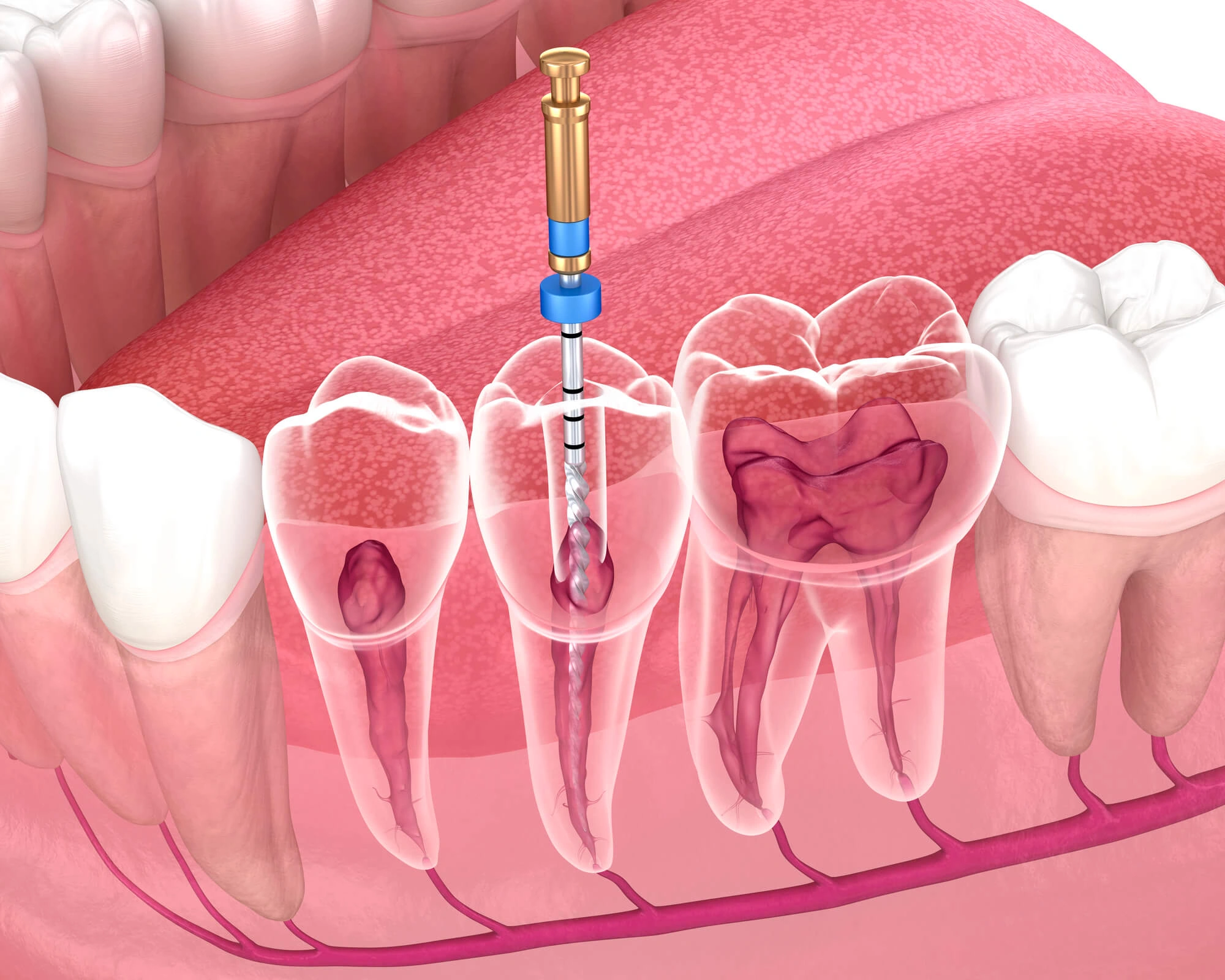 3D Illustration of root canal Hillsborough