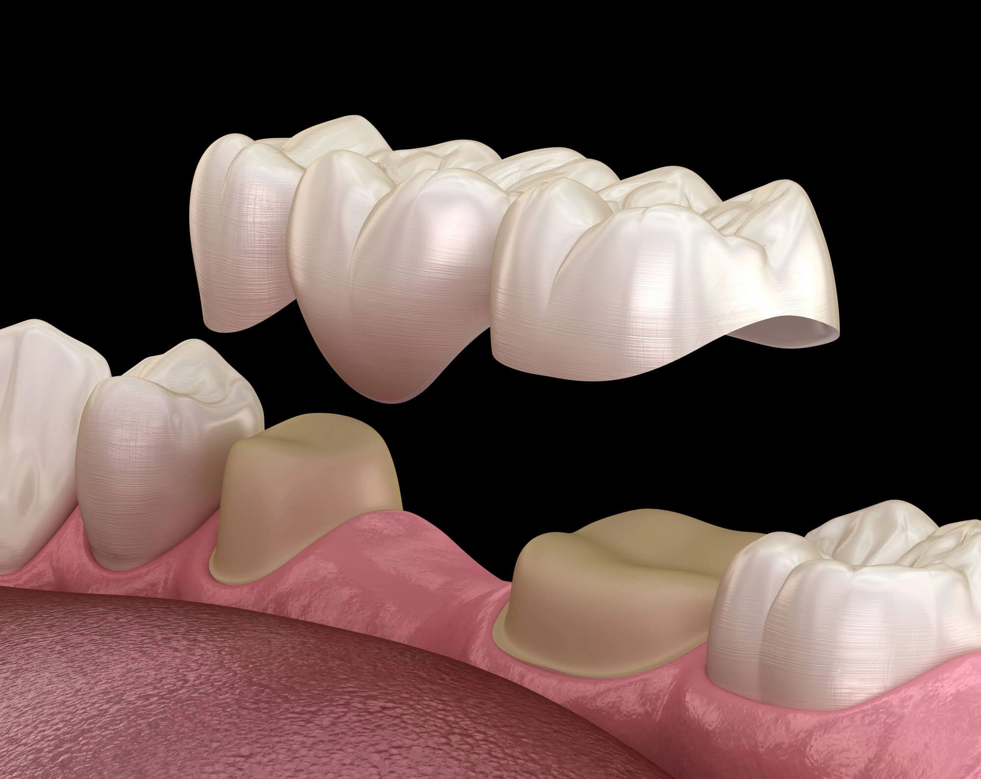 dental bridge Hillsborough