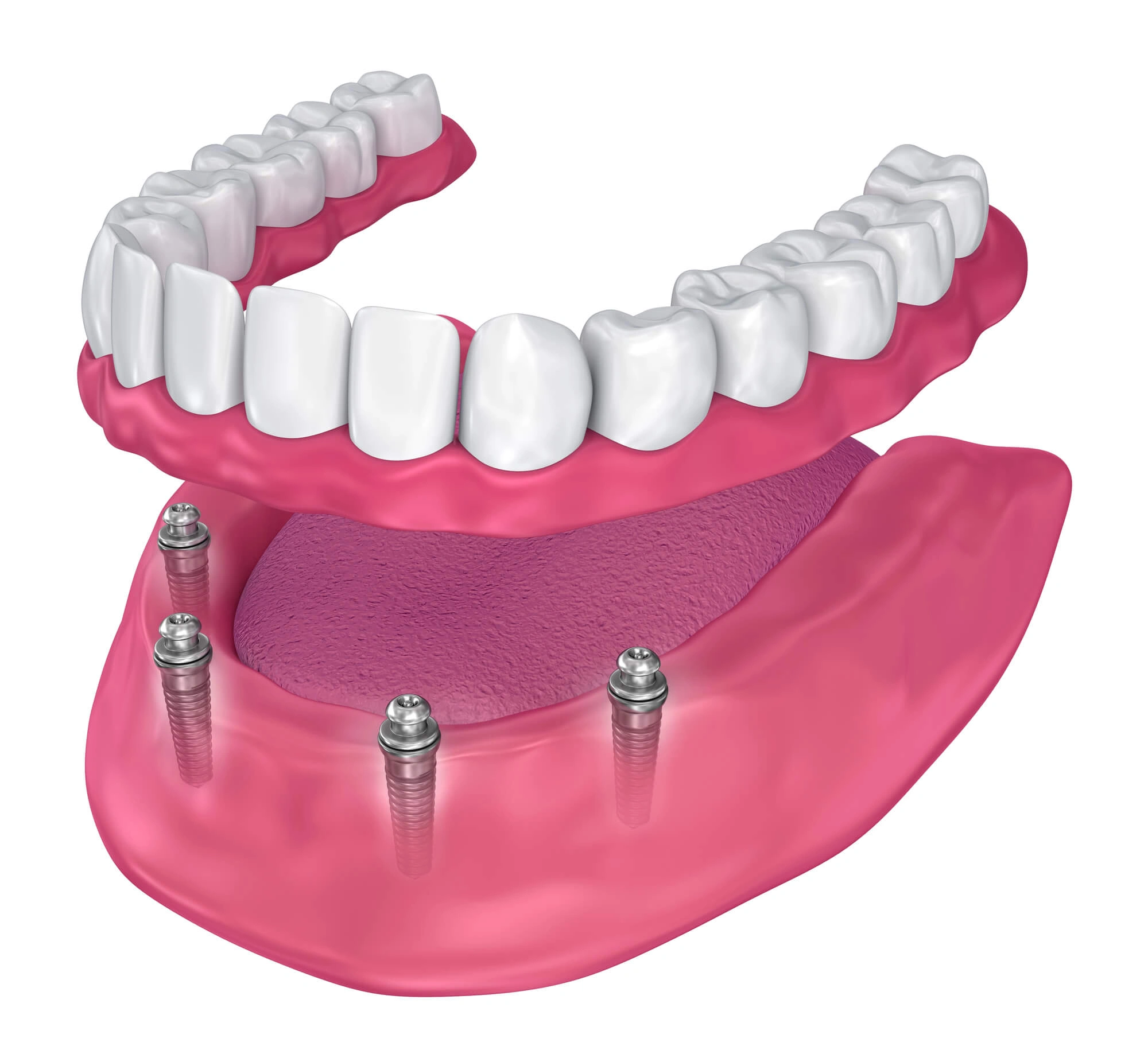 Woman undergoing affordable denture implants