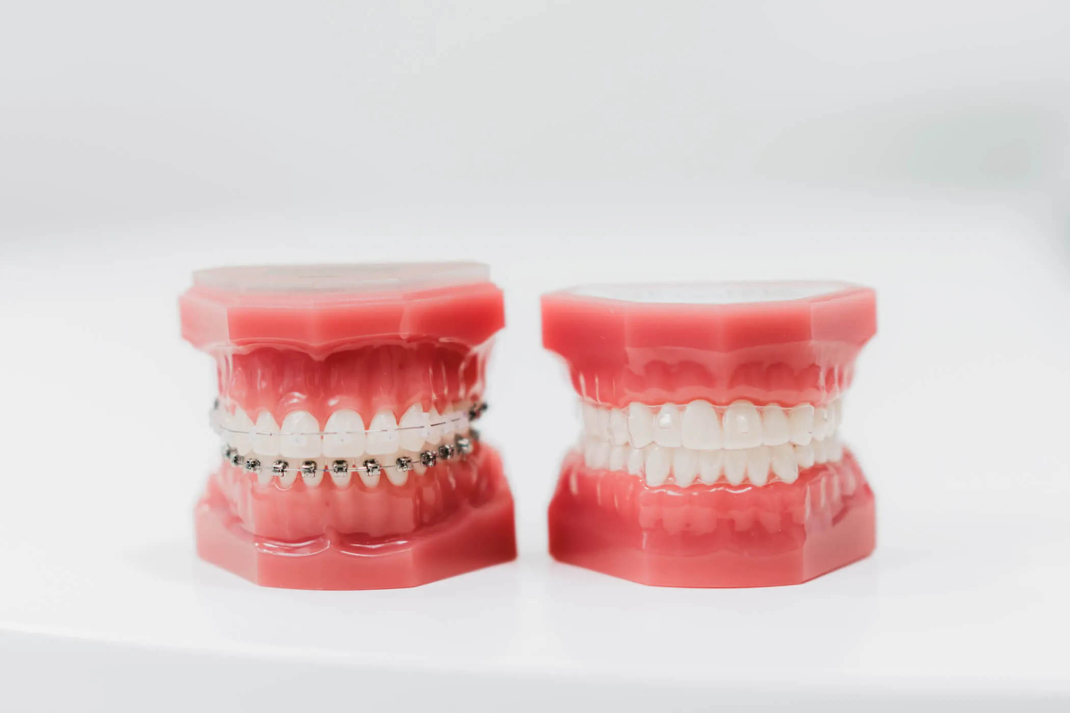 aparat-staly-a-nakladki-ortodontyczne-porownanie-dental-wilanow