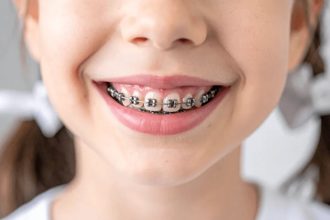 dziewczynka-z-metalowym-aparatem-na-zebach-ortodonta-dla-dzieci-wilanow-warszawa