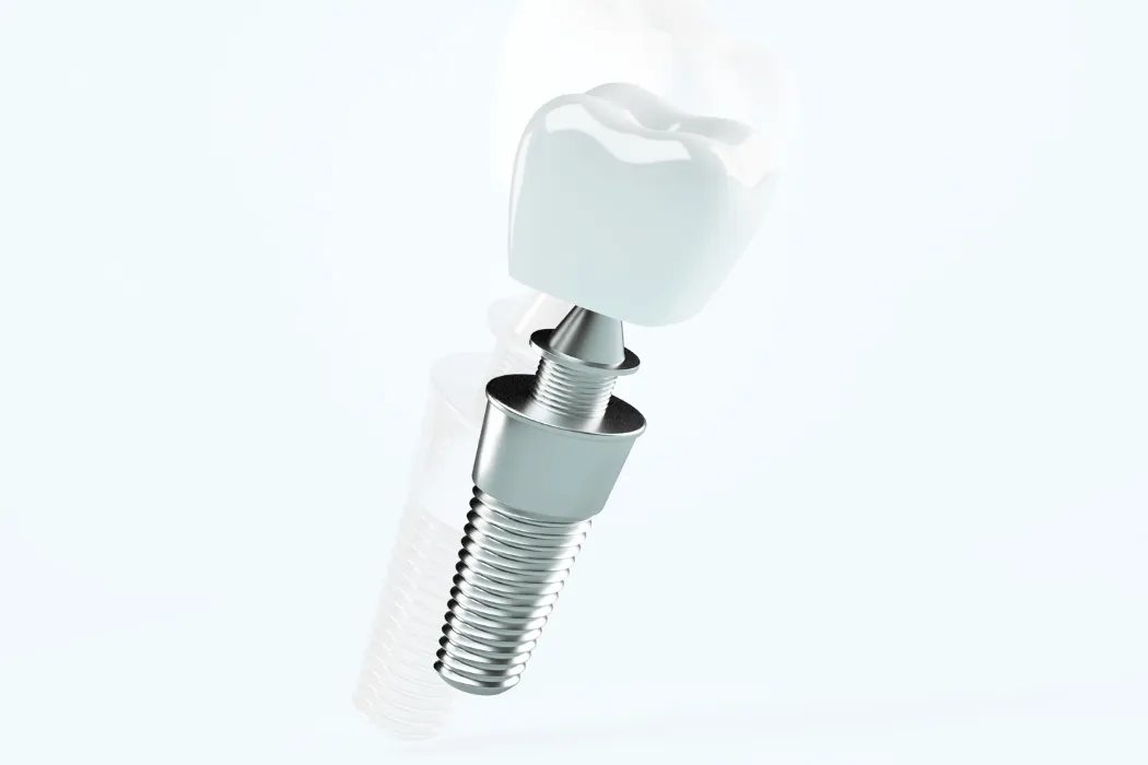implant-zebowy