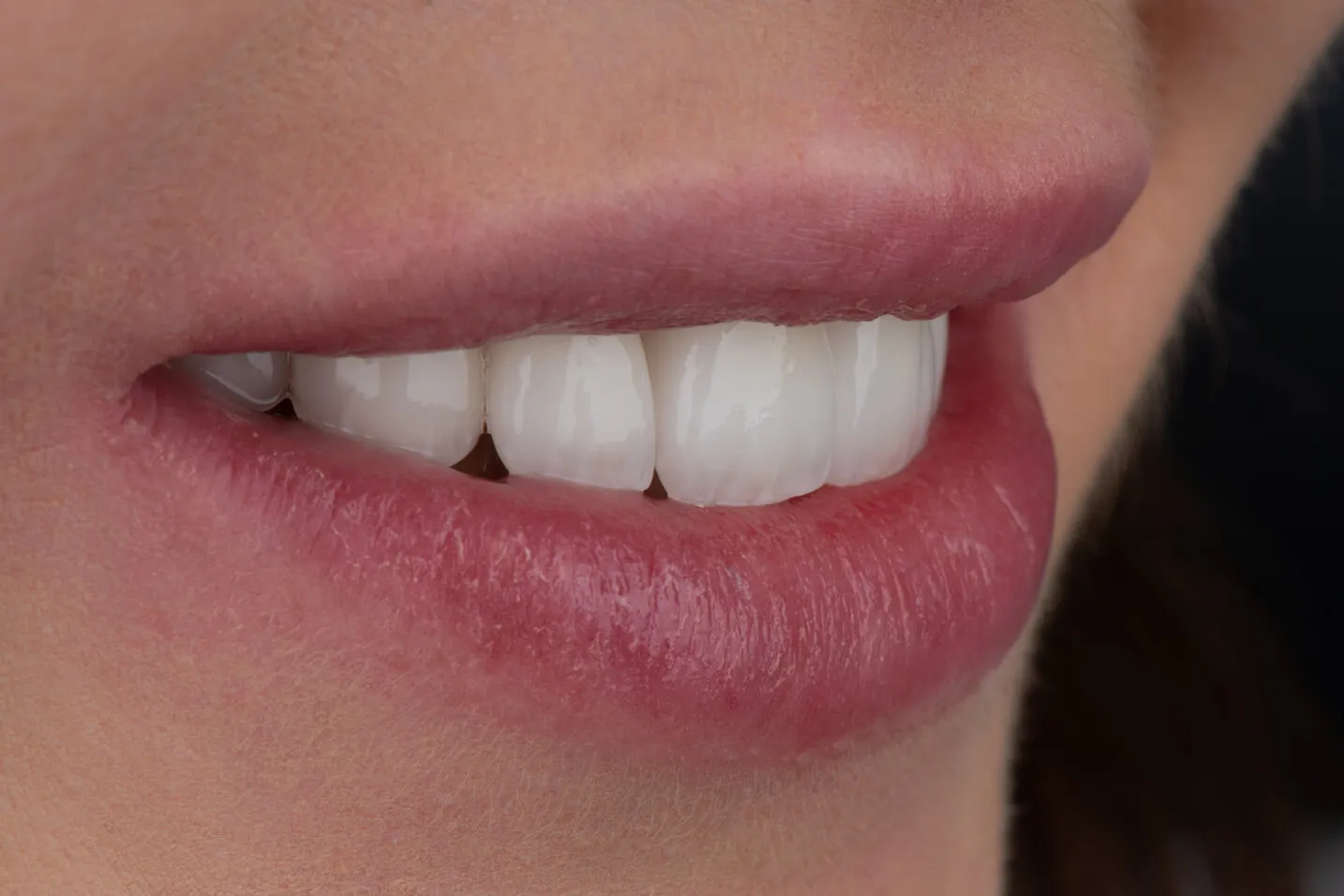 dental-wilanow-warszawa-licowki