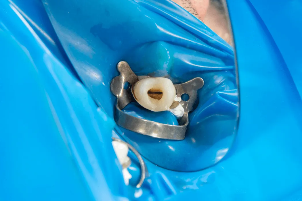 endodoncja-warszawa-wilanow-leczenie-zeba