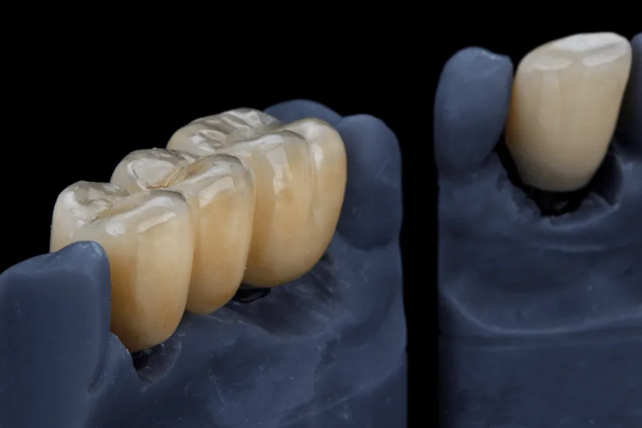 rekonstrukcja-zeba-skan-3d-cad-cam-dental-wilanow