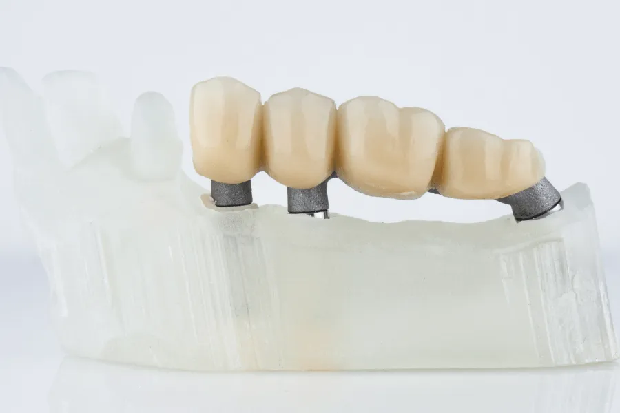 most-protetyczny-naturalna-estetyka-wilanow-warszawa