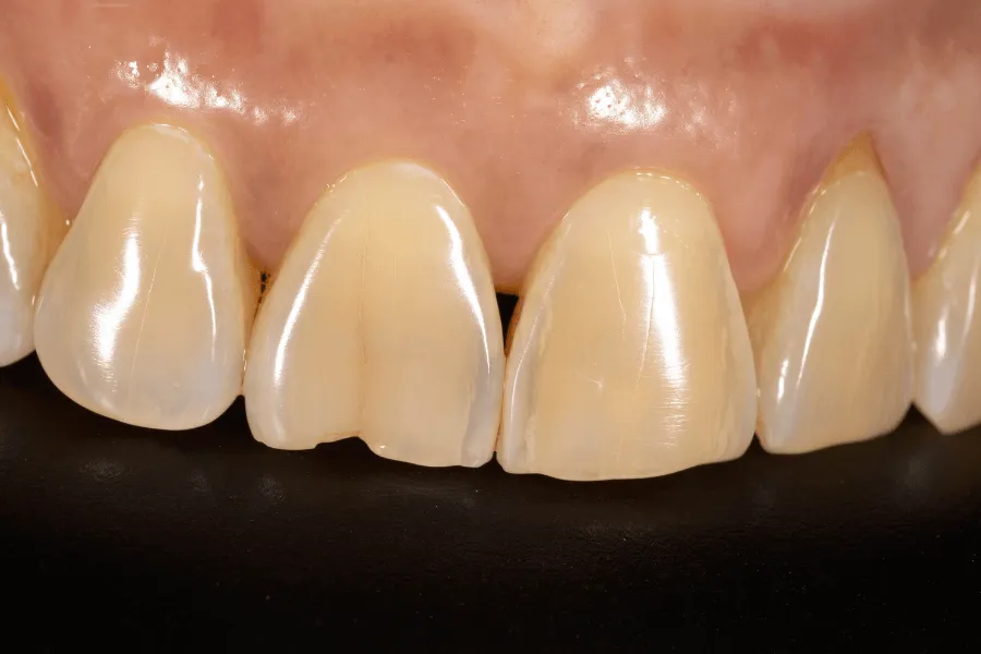 naprawa-ukruszonego-zeba-przed