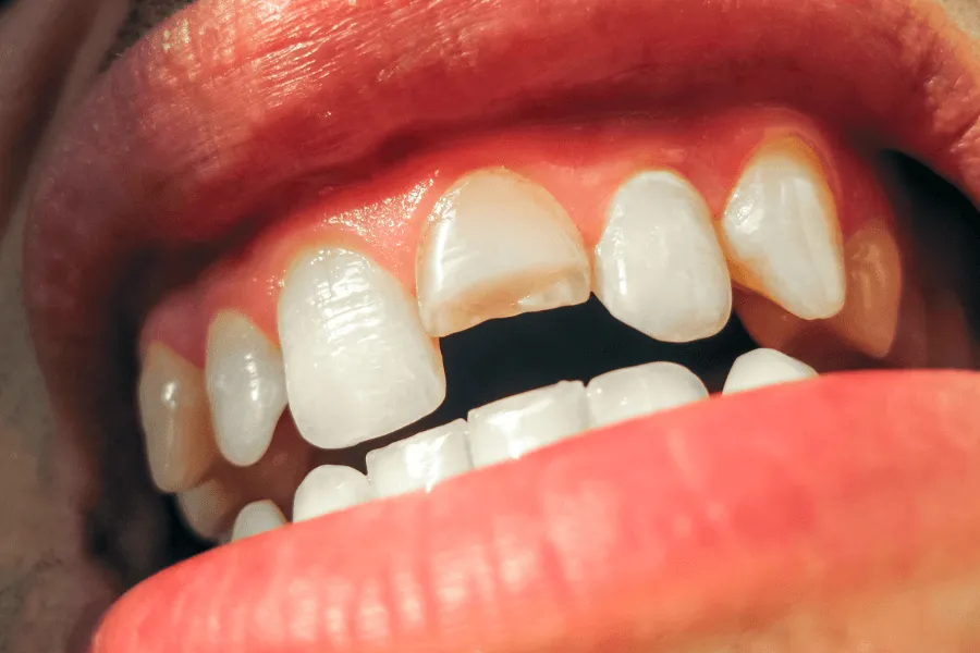 ukruszony-zab-leczenie-wilanow