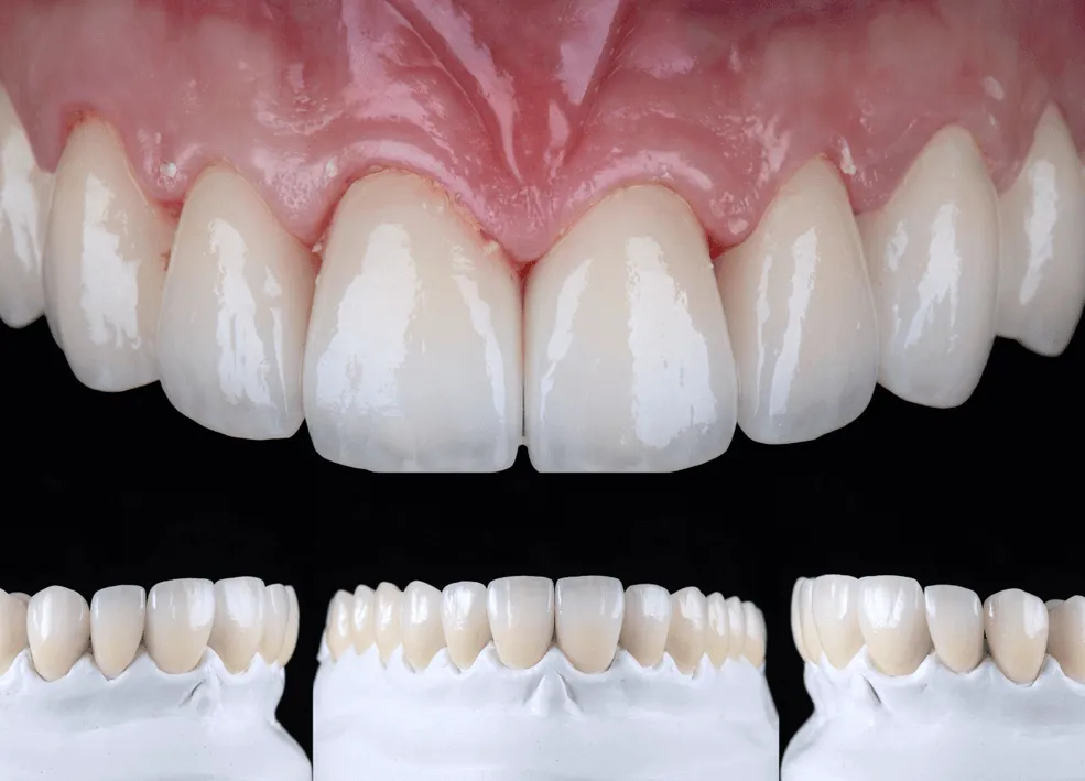 nowy-usmiech-dzieki-implantom-dr-filip-brzozowski