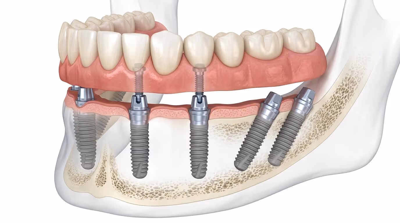 Widok z góry protezy na implantach w modelu dentystycznym