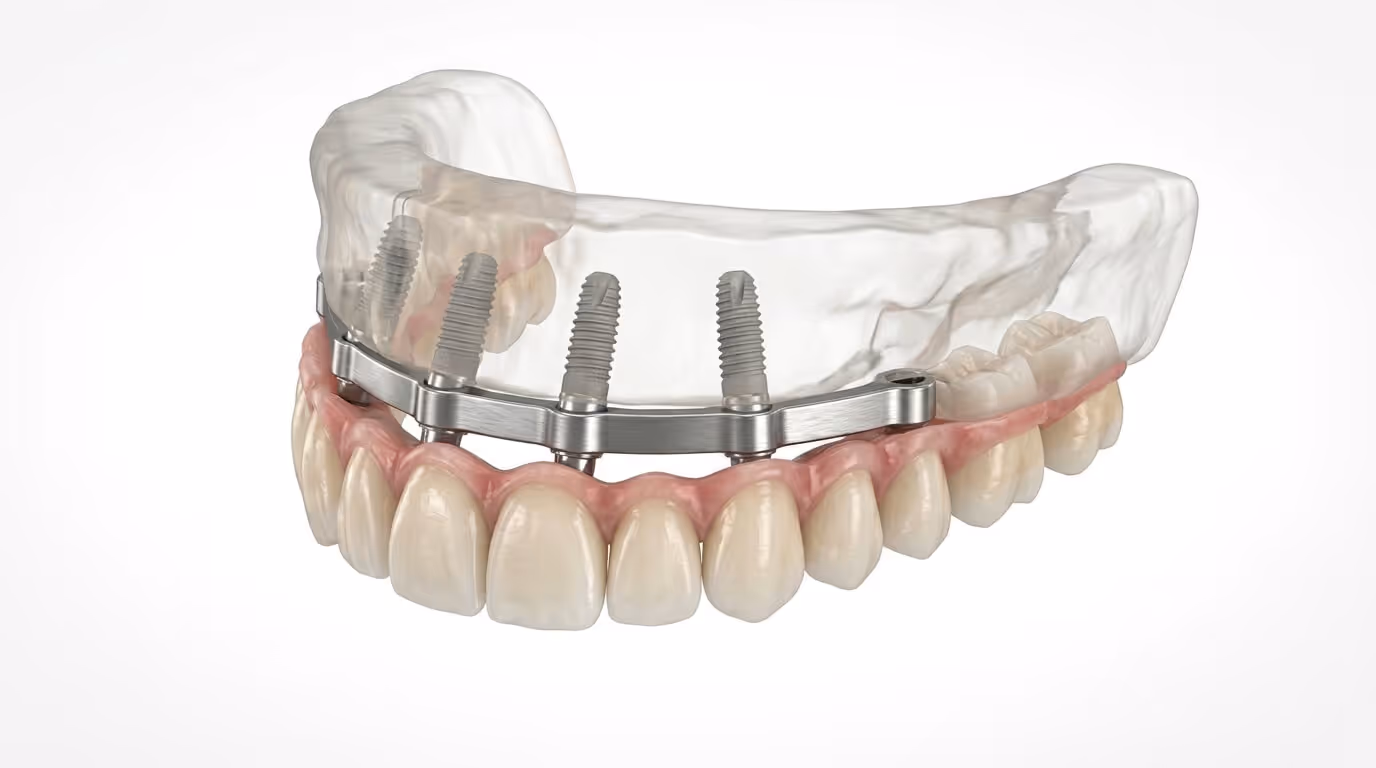 Widok górny protezy na implantach w modelu dentystycznym