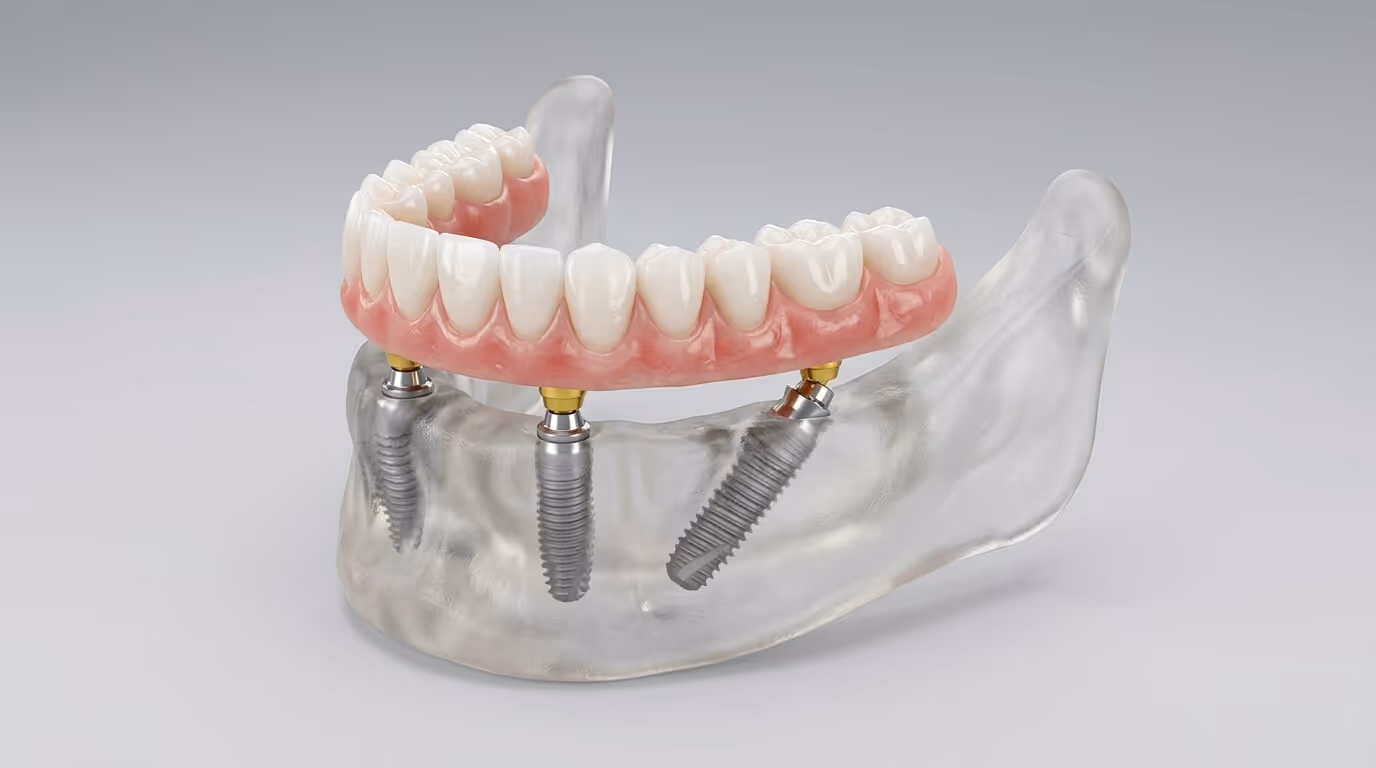Model dolnej szczęki z protezą mocowaną na implantach, widok od frontu