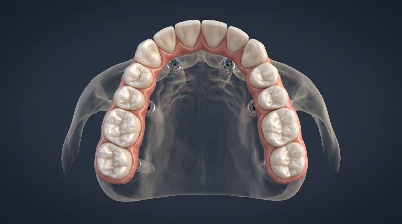 Dolna szczęka z protezą All-on-4 zamocowaną na czterech implantach
