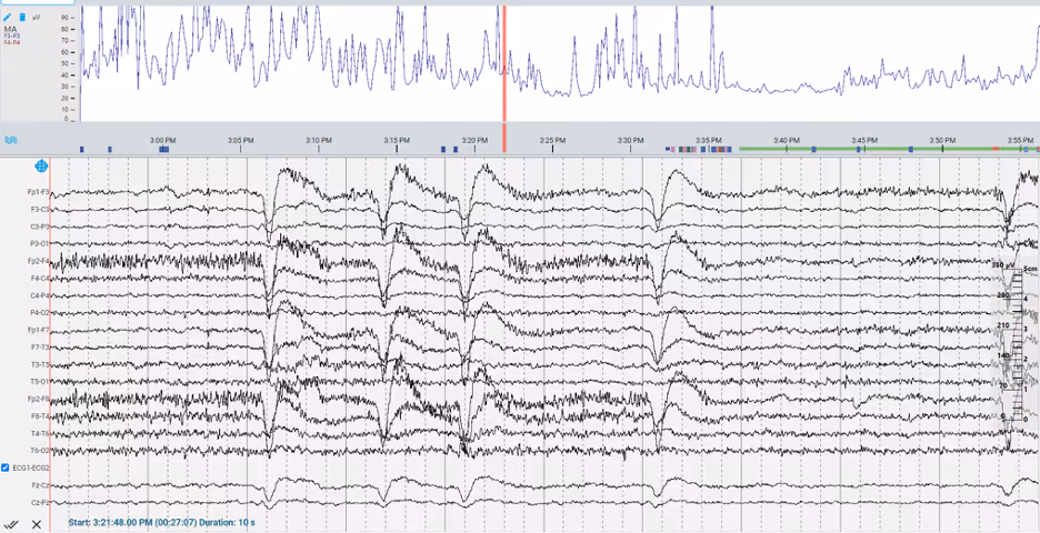 Figure 2. Median amplitude trend with electrode pairs F3-P3 and F4-P4