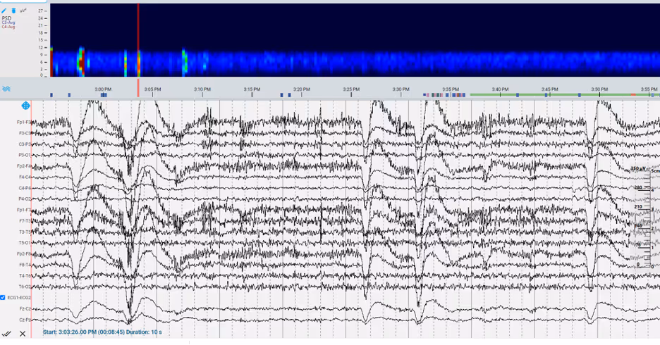 Figure 1. Frequency trend – electrodes C3 and C4 – 5-10 Hz band