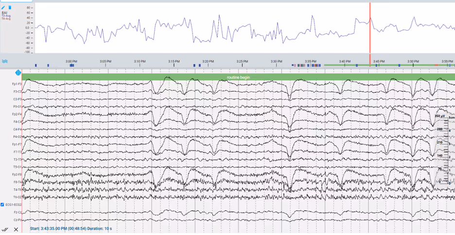 Figure 3. Brain asymmetry index – at this point in the recording reflects higher amplitude faster frequencies over the right hemisphere compared to the left.