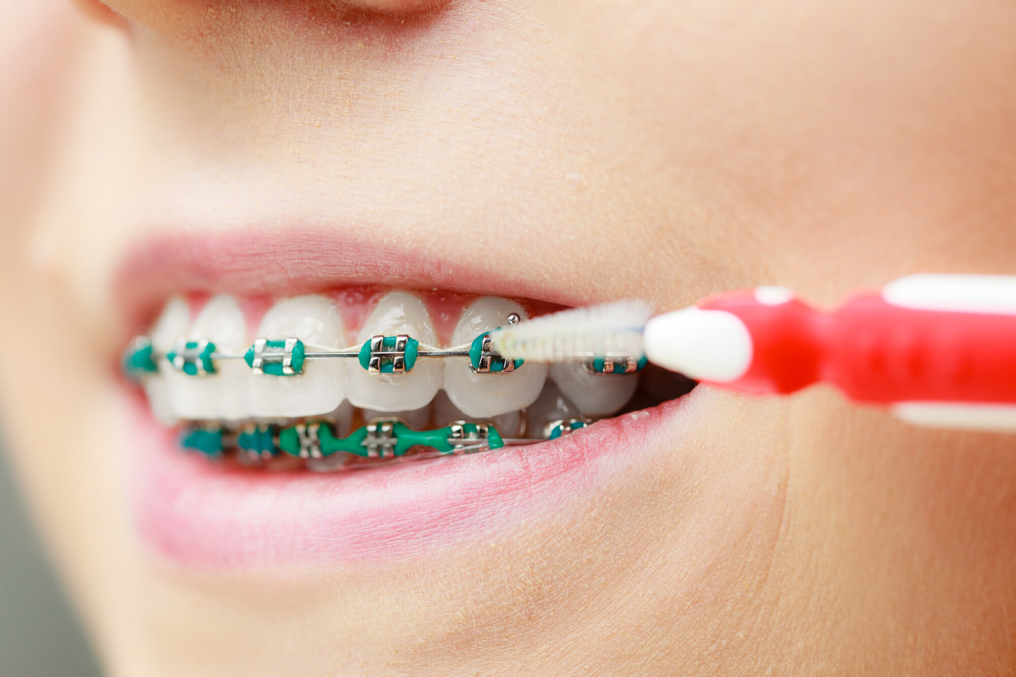 Orthodontist in Franklin TN Advices Using Interdental Brushes