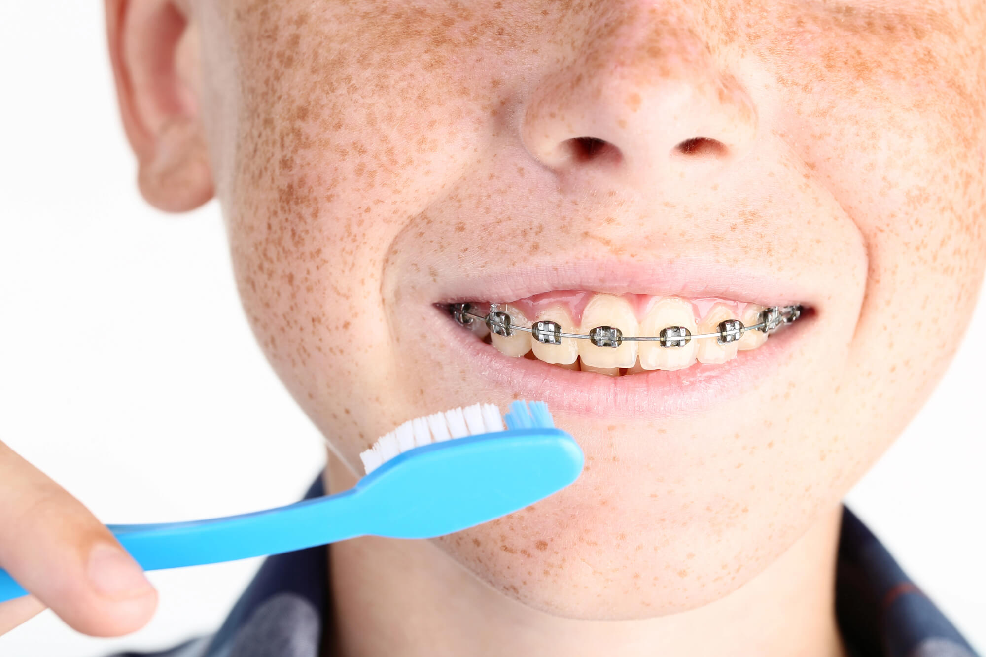 Orthodontist in Franklin TN Tips for Brushing with Braces